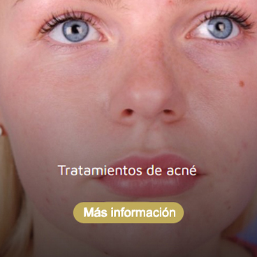 Tratamientos de acné Roquetas de Mar Almería