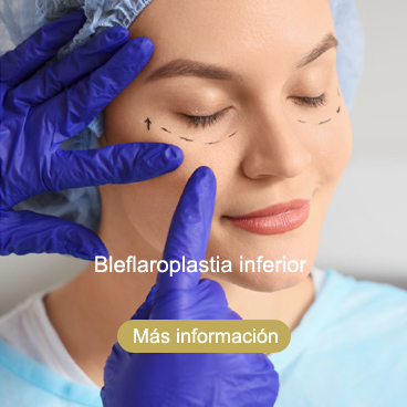bleflaroplastia inferior Roquetas de Mar Almería