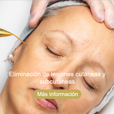 eliminación de lesiones cutáneas y subcutáneas Roquetas de Mar Almería