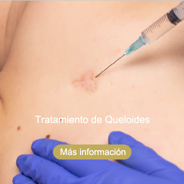 tratamiento de queloides Roquetas de Mar Almería